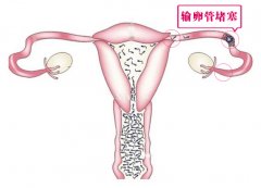 输卵管堵塞要怎么治